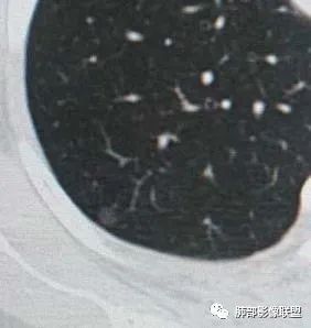 【病例】犹抱琵笆半遮面的肺腺癌 【病例】犹抱琵笆半遮面的肺腺癌