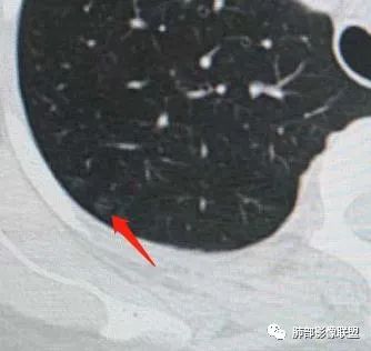 【病例】犹抱琵笆半遮面的肺腺癌 【病例】犹抱琵笆半遮面的肺腺癌