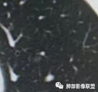 【病例】犹抱琵笆半遮面的肺腺癌 【病例】犹抱琵笆半遮面的肺腺癌