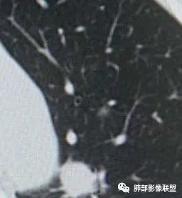 【病例】犹抱琵笆半遮面的肺腺癌 【病例】犹抱琵笆半遮面的肺腺癌