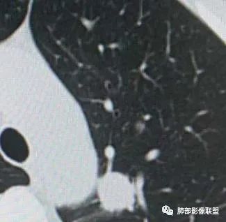 【病例】犹抱琵笆半遮面的肺腺癌 【病例】犹抱琵笆半遮面的肺腺癌