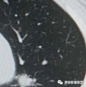 【病例】犹抱琵笆半遮面的肺腺癌 【病例】犹抱琵笆半遮面的肺腺癌
