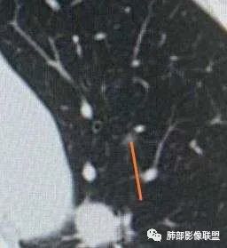 【病例】犹抱琵笆半遮面的肺腺癌 【病例】犹抱琵笆半遮面的肺腺癌