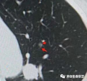【病例】犹抱琵笆半遮面的肺腺癌 【病例】犹抱琵笆半遮面的肺腺癌
