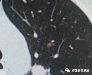 【病例】犹抱琵笆半遮面的肺腺癌 【病例】犹抱琵笆半遮面的肺腺癌