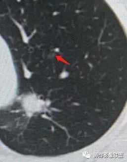 【病例】犹抱琵笆半遮面的肺腺癌 【病例】犹抱琵笆半遮面的肺腺癌