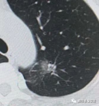 【病例】犹抱琵笆半遮面的肺腺癌 【病例】犹抱琵笆半遮面的肺腺癌