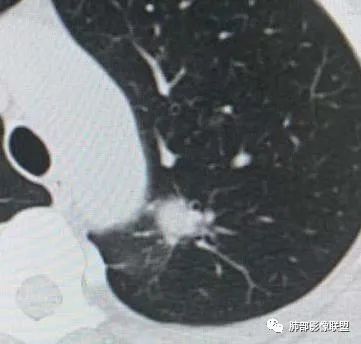 【病例】犹抱琵笆半遮面的肺腺癌 【病例】犹抱琵笆半遮面的肺腺癌