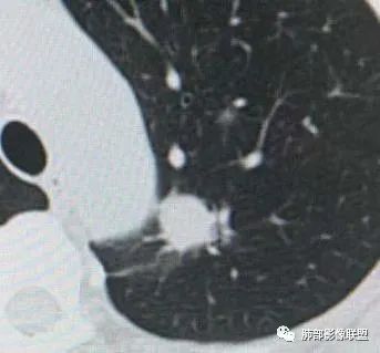 【病例】犹抱琵笆半遮面的肺腺癌 【病例】犹抱琵笆半遮面的肺腺癌