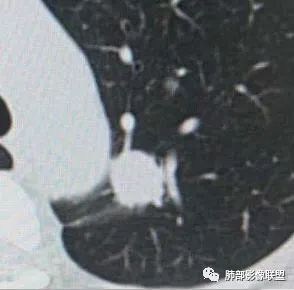 【病例】犹抱琵笆半遮面的肺腺癌 【病例】犹抱琵笆半遮面的肺腺癌