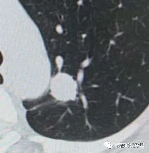 【病例】犹抱琵笆半遮面的肺腺癌 【病例】犹抱琵笆半遮面的肺腺癌