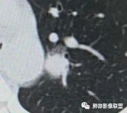 【病例】犹抱琵笆半遮面的肺腺癌