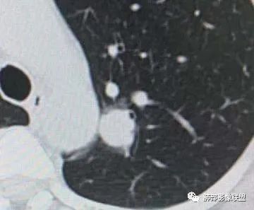 【病例】犹抱琵笆半遮面的肺腺癌 【病例】犹抱琵笆半遮面的肺腺癌