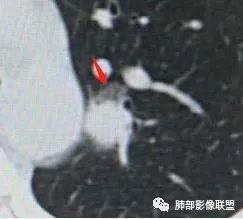 【病例】犹抱琵笆半遮面的肺腺癌 【病例】犹抱琵笆半遮面的肺腺癌