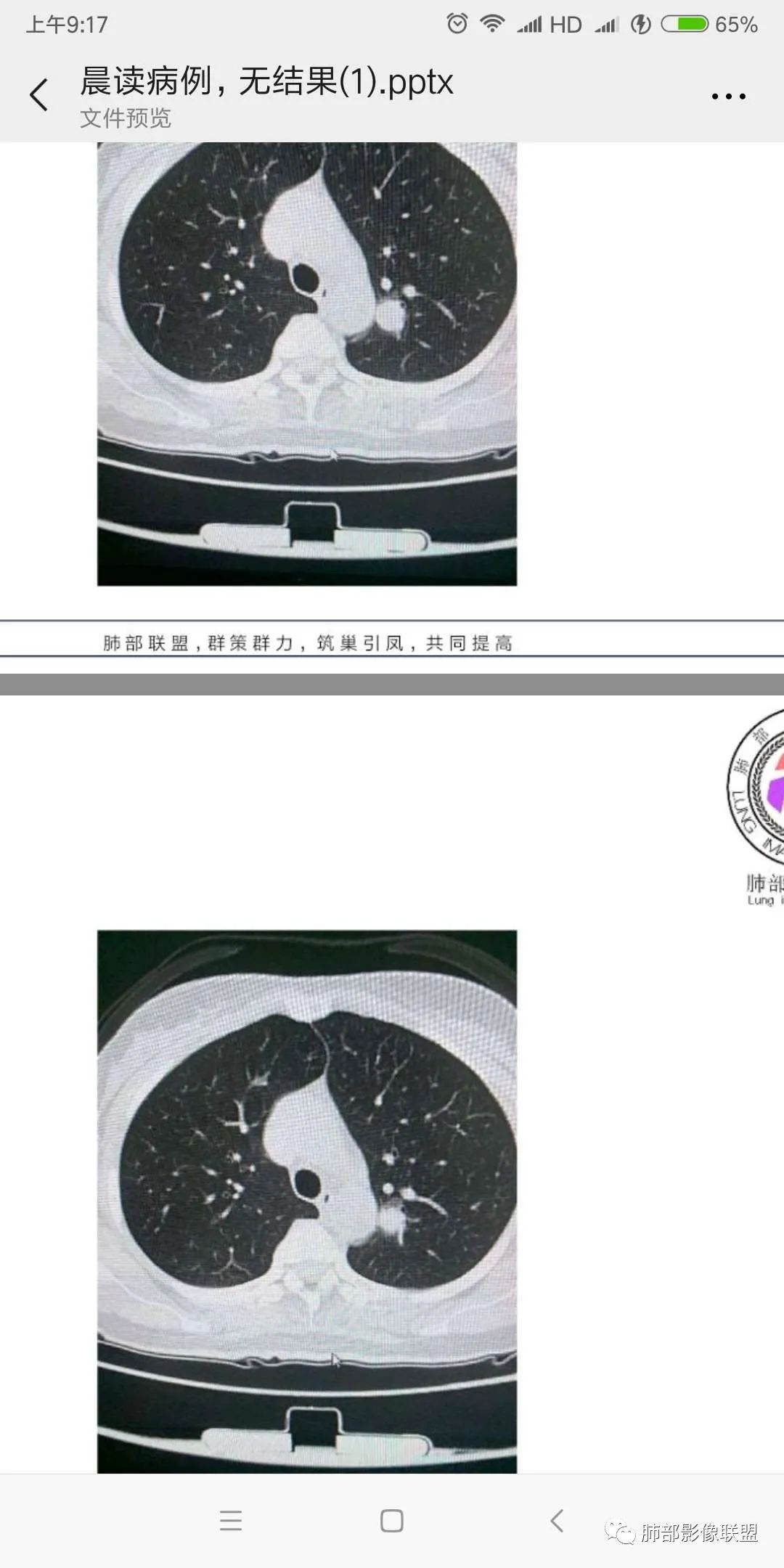 【病例】犹抱琵笆半遮面的肺腺癌 【病例】犹抱琵笆半遮面的肺腺癌