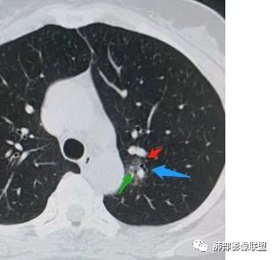 【病例】犹抱琵笆半遮面的肺腺癌 【病例】犹抱琵笆半遮面的肺腺癌