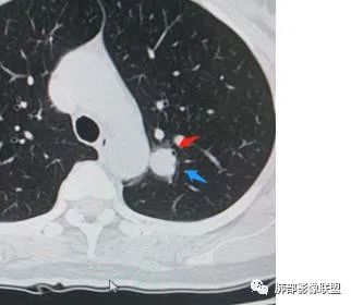 【病例】犹抱琵笆半遮面的肺腺癌 【病例】犹抱琵笆半遮面的肺腺癌