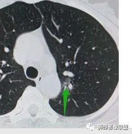 【病例】犹抱琵笆半遮面的肺腺癌 【病例】犹抱琵笆半遮面的肺腺癌