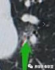 【病例】犹抱琵笆半遮面的肺腺癌 【病例】犹抱琵笆半遮面的肺腺癌