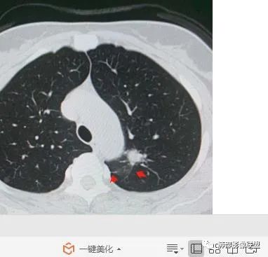 【病例】犹抱琵笆半遮面的肺腺癌 【病例】犹抱琵笆半遮面的肺腺癌