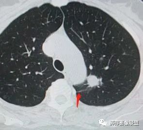 【病例】犹抱琵笆半遮面的肺腺癌 【病例】犹抱琵笆半遮面的肺腺癌