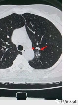 【病例】犹抱琵笆半遮面的肺腺癌 【病例】犹抱琵笆半遮面的肺腺癌