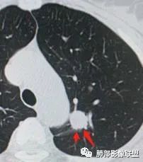 【病例】犹抱琵笆半遮面的肺腺癌 【病例】犹抱琵笆半遮面的肺腺癌