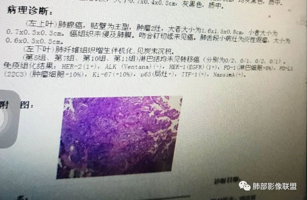【病例】犹抱琵笆半遮面的肺腺癌 【病例】犹抱琵笆半遮面的肺腺癌