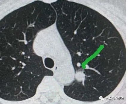 【病例】犹抱琵笆半遮面的肺腺癌 【病例】犹抱琵笆半遮面的肺腺癌