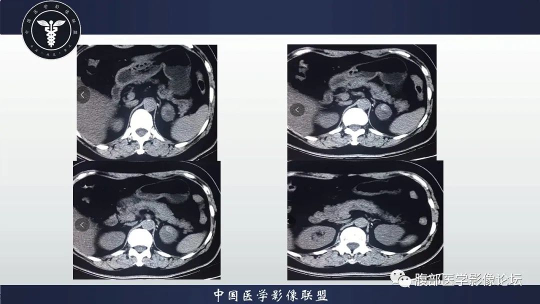 【病例】左肾癌(肾透明细胞癌)一例CT及MR影像 【病例】左肾癌(肾透明细胞癌)一例CT及MR影像