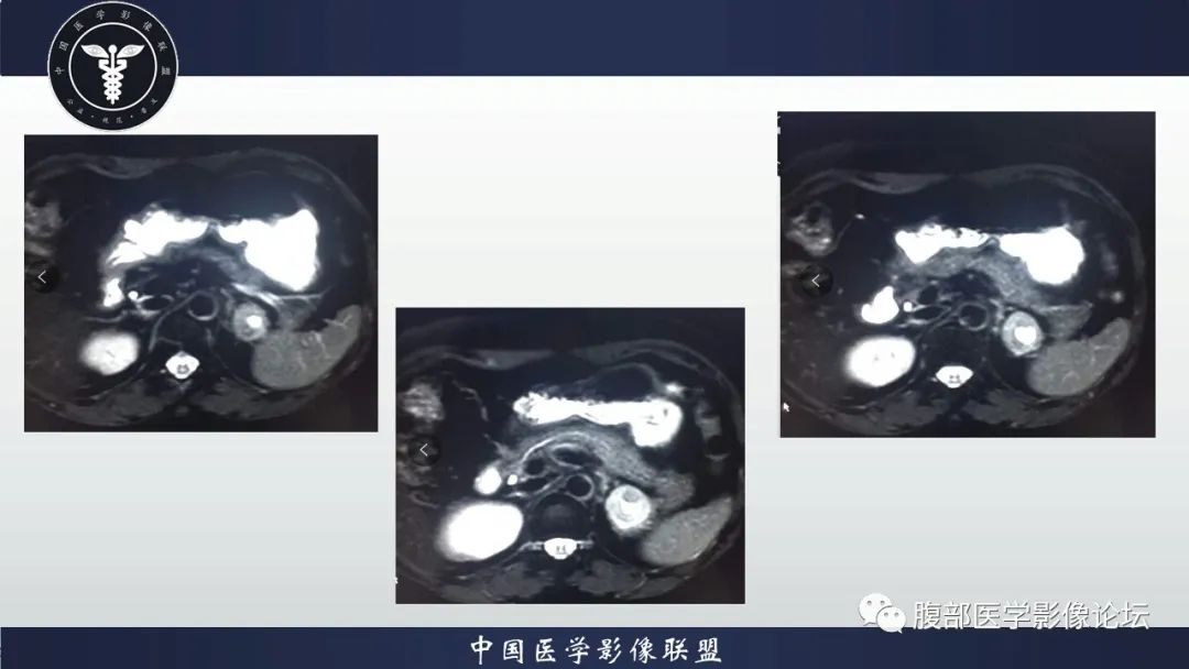 【病例】左肾癌(肾透明细胞癌)一例CT及MR影像 【病例】左肾癌(肾透明细胞癌)一例CT及MR影像