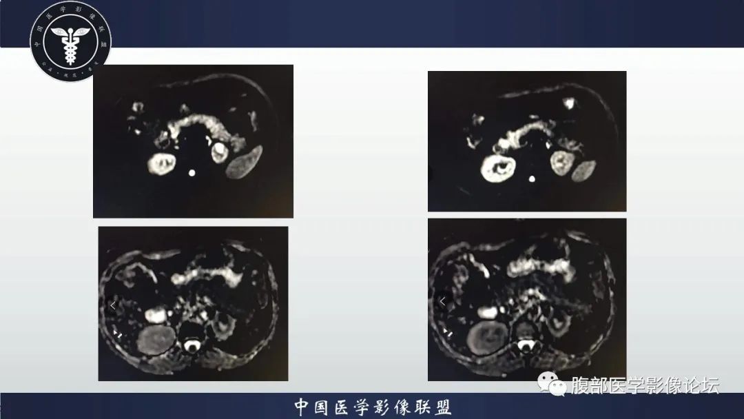 【病例】左肾癌(肾透明细胞癌)一例CT及MR影像 【病例】左肾癌(肾透明细胞癌)一例CT及MR影像