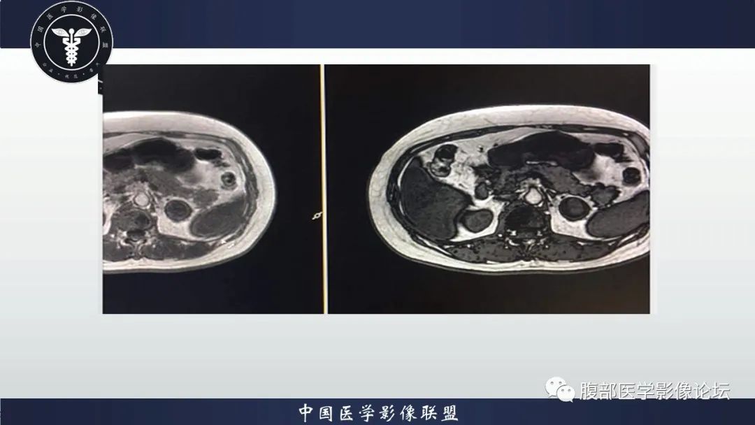 【病例】左肾癌(肾透明细胞癌)一例CT及MR影像 【病例】左肾癌(肾透明细胞癌)一例CT及MR影像