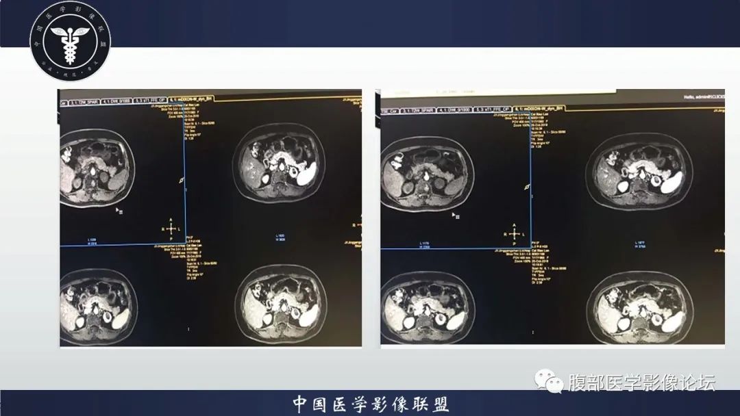 【病例】左肾癌(肾透明细胞癌)一例CT及MR影像 【病例】左肾癌(肾透明细胞癌)一例CT及MR影像