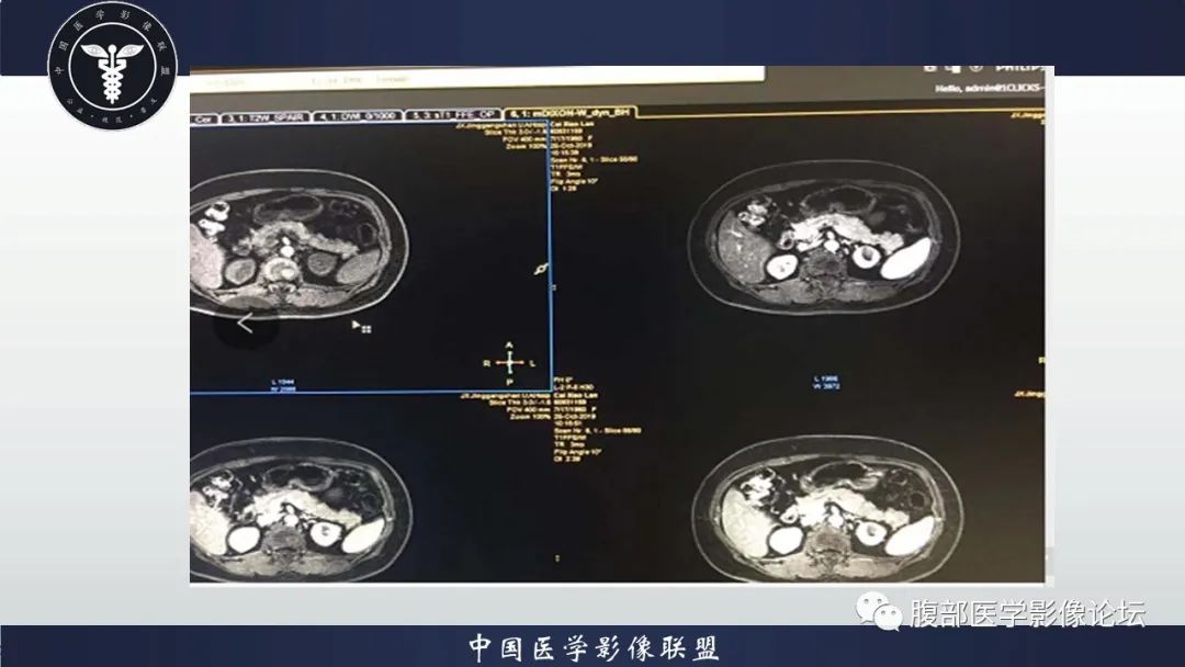 【病例】左肾癌(肾透明细胞癌)一例CT及MR影像 【病例】左肾癌(肾透明细胞癌)一例CT及MR影像