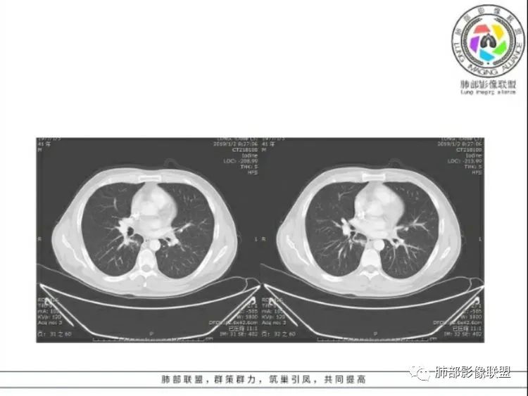 【病例】 肺白塞氏病1例CT影像讨论 【病例】 肺白塞氏病1例CT影像讨论
