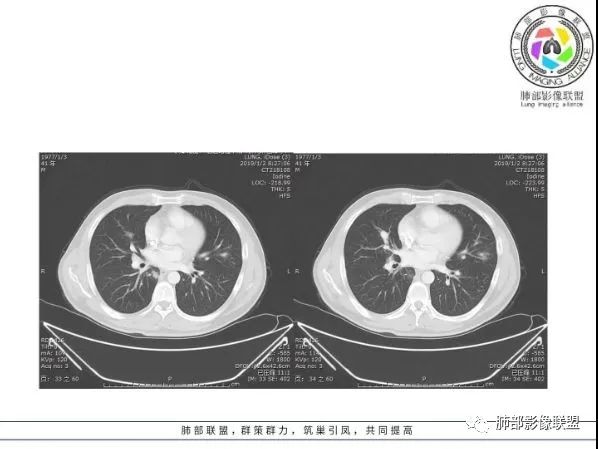 【病例】 肺白塞氏病1例CT影像讨论 【病例】 肺白塞氏病1例CT影像讨论