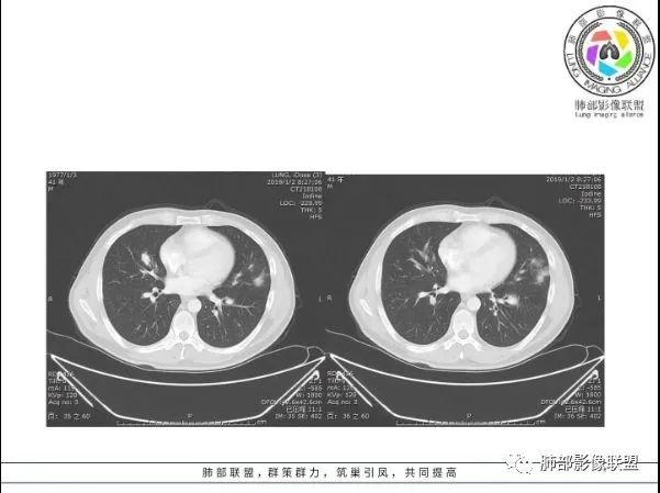 【病例】 肺白塞氏病1例CT影像讨论 【病例】 肺白塞氏病1例CT影像讨论