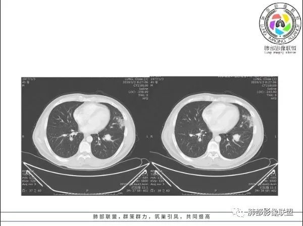 【病例】 肺白塞氏病1例CT影像讨论 【病例】 肺白塞氏病1例CT影像讨论