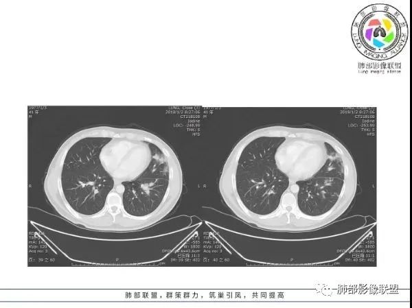 【病例】 肺白塞氏病1例CT影像讨论 【病例】 肺白塞氏病1例CT影像讨论