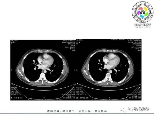 【病例】 肺白塞氏病1例CT影像讨论 【病例】 肺白塞氏病1例CT影像讨论