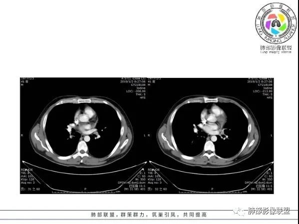 【病例】 肺白塞氏病1例CT影像讨论 【病例】 肺白塞氏病1例CT影像讨论