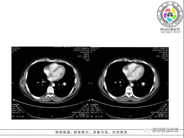 【病例】 肺白塞氏病1例CT影像讨论 【病例】 肺白塞氏病1例CT影像讨论