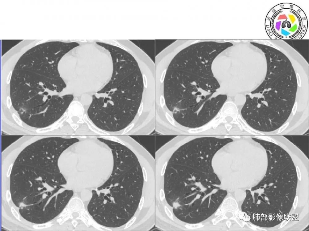 【病例】肺隐球菌病2例CT影像讨论 【病例】肺隐球菌病2例CT影像讨论