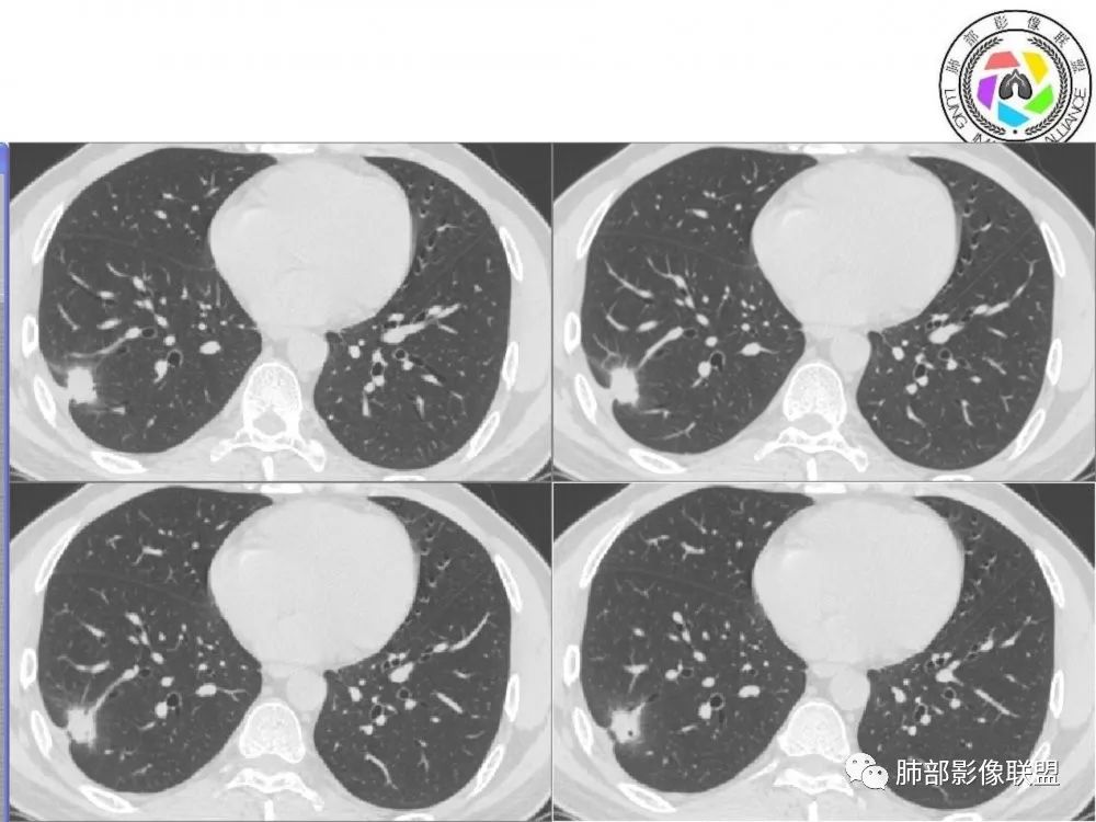 【病例】肺隐球菌病2例CT影像讨论 【病例】肺隐球菌病2例CT影像讨论