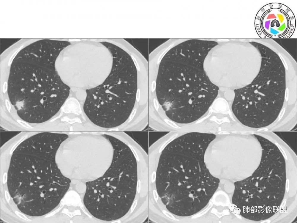 【病例】肺隐球菌病2例CT影像讨论 【病例】肺隐球菌病2例CT影像讨论