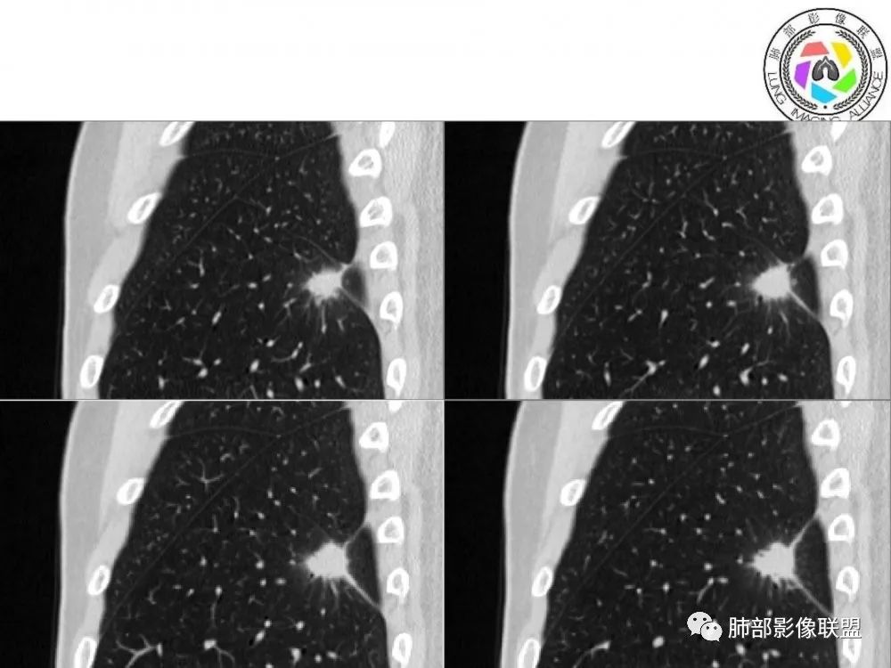 【病例】肺隐球菌病2例CT影像讨论 【病例】肺隐球菌病2例CT影像讨论