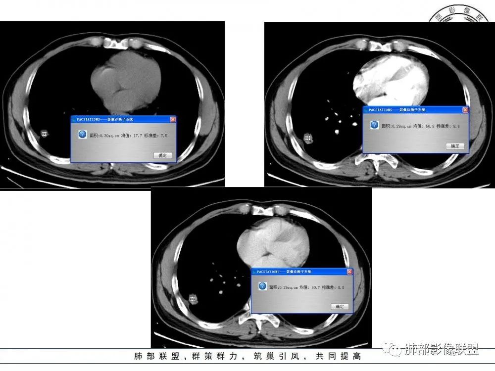 【病例】肺隐球菌病2例CT影像讨论 【病例】肺隐球菌病2例CT影像讨论
