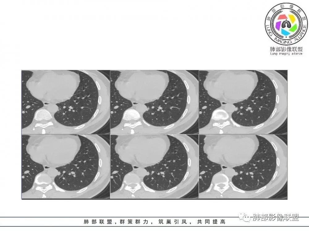 【病例】肺隐球菌病2例CT影像讨论 【病例】肺隐球菌病2例CT影像讨论