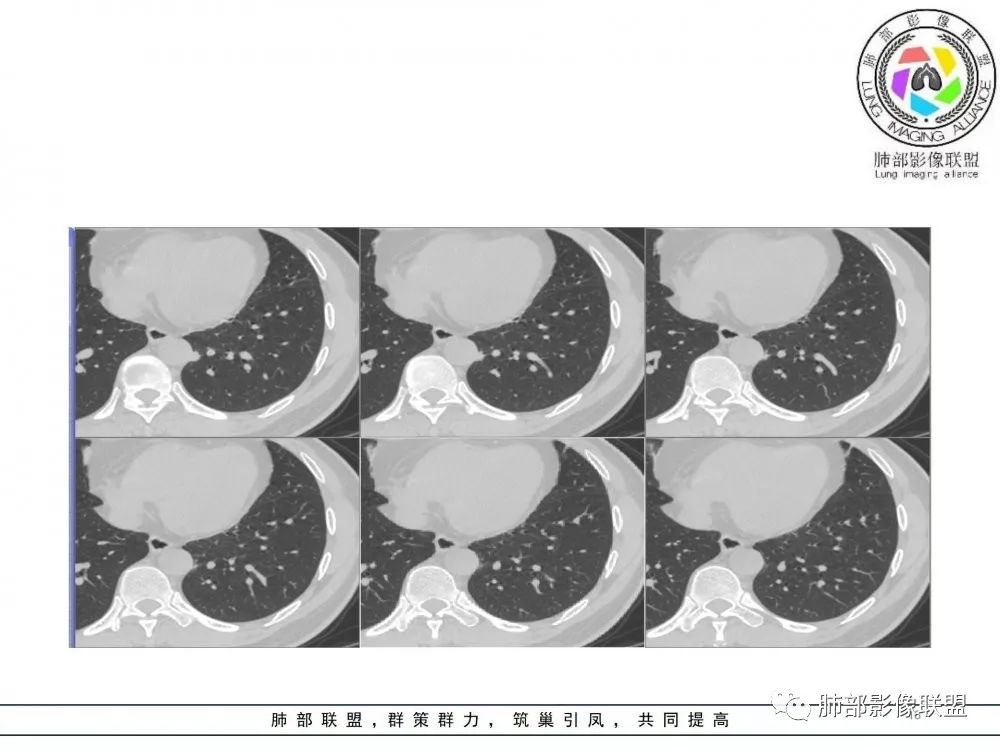 【病例】肺隐球菌病2例CT影像讨论 【病例】肺隐球菌病2例CT影像讨论